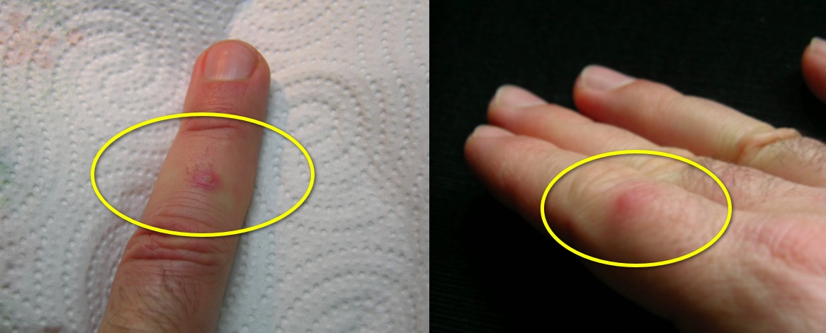In evidenza alcuni casi arrossamenti - rigonfiamenti doloranti dopo una azione manutentiva con mani in vasca…